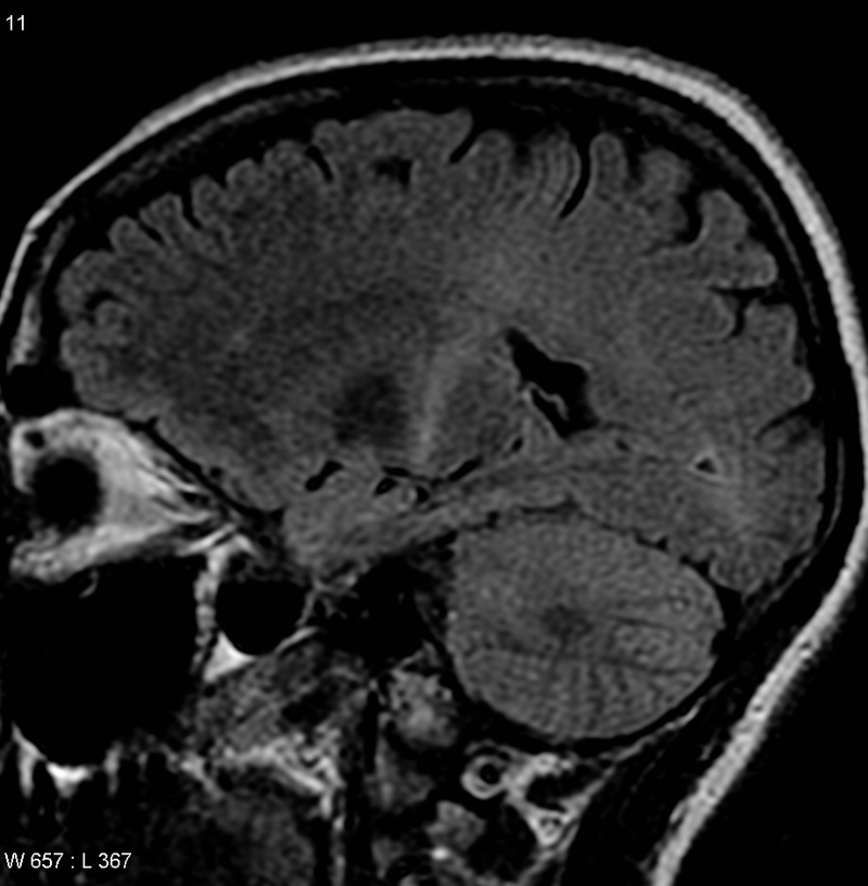 MRI de una persona con esclerosis lateral amiotrófica. Wikimedia Commons